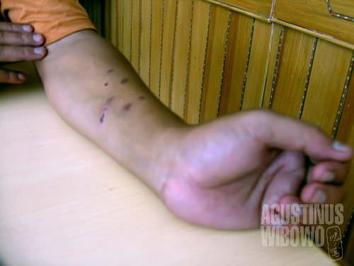 Bekas-bekas luka yang konon akibat siksaan tentara China. (AGUSTINUS WIBOWO)